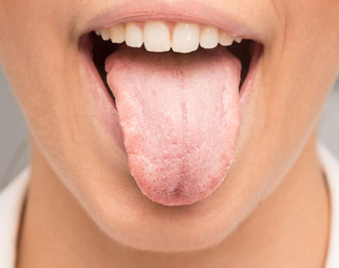 Dry Mouth – Facts and Tips - treatment at westharbor dental  
