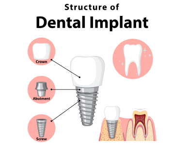 Your Guide to Dental Implants: Restoring Smiles in Port Clinton, OH - treatment at westharbor dental  